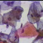 Διακριτική κοιλοκυττάρωση